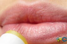 Como tratar de forma natural el herpes labial
