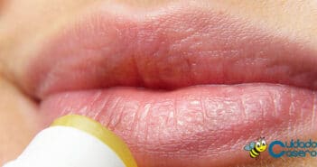 Como tratar de forma natural el herpes labial